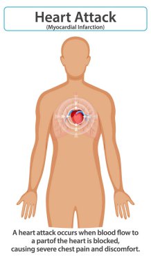 Kalp krizinin ve semptomlarının göstergesi.