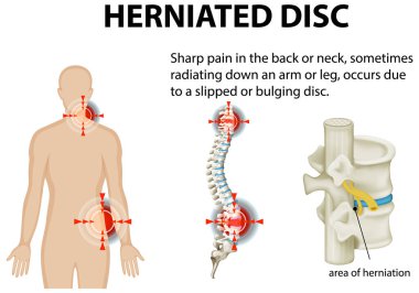 Fıtıklaşmış disk ve ağrı bölgelerinin çizimi