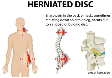 Illustration of herniated disc and pain areas clipart