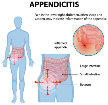 İltihaplı apandis ve karın ağrısı.