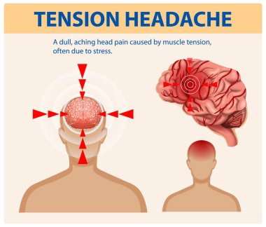 Gerilim, baş ağrısı ve beyin anatomisi.