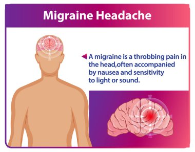 Migren ağrısı ve semptomların göstergesi.