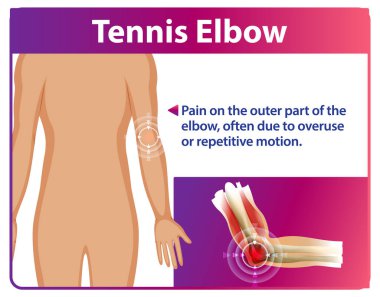 Tenis tasviri dirsek ağrısı ve anatomi