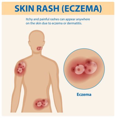 İnsan derisinde egzama belirtileri.