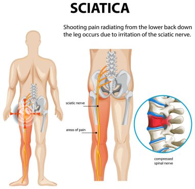 Illustration of sciatica nerve pain and spinal compression clipart