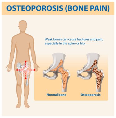Kemik sağlığı ve osteoporoz etkilerinin gösterimi