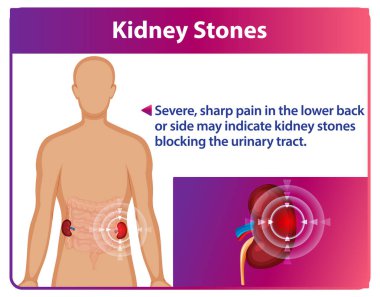 Illustration of kidney stones and associated pain clipart