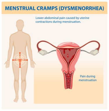 Adet sancısı ve rahim kasılmaları.
