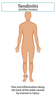 Diagram showing Achilles tendon pain and inflammation clipart