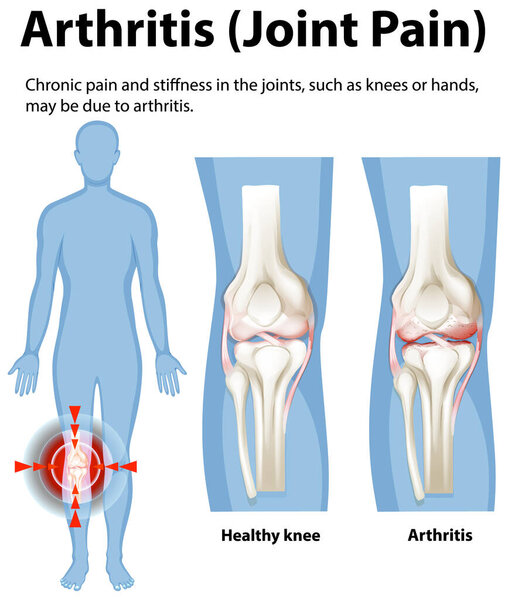 Illustration of knee joint health and arthritis
