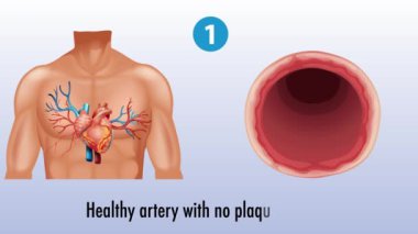 Ateroskleroz arterlerde aşamalar