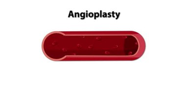 Balon anjiyoplasti sürecinin görsel rehberi