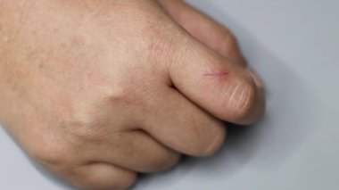 Parmağındaki kesiğin sıralı iyileşmesi.