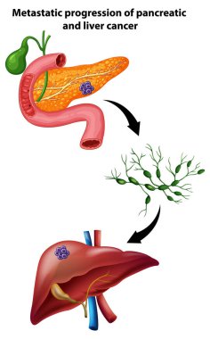 Illustration of cancer spreading to the liver clipart