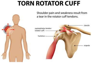 Omuz anatomisi ve yaralanma detayları