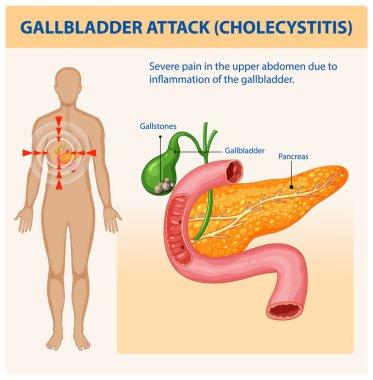 Safra kesesi iltihabı ve ağrı belirtileri.