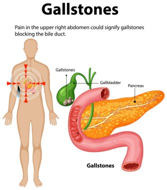 Illustration of gallstones affecting the gallbladder and pancreas clipart