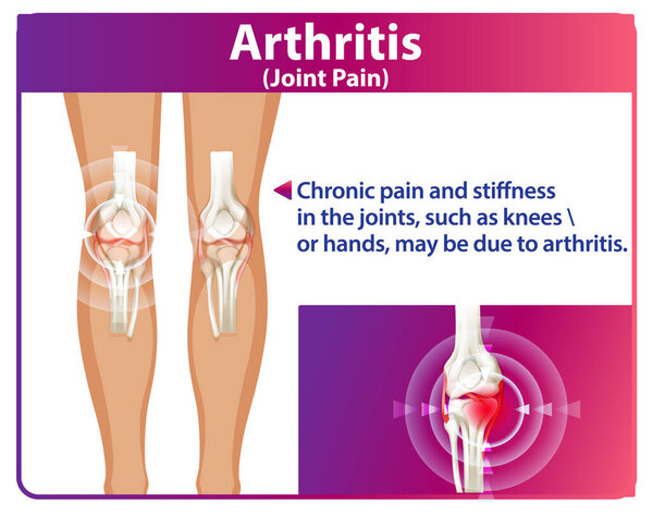 Illustration of arthritis affecting knee joints