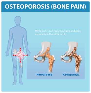 Kemik sağlığı ve osteoporoz etkilerinin gösterimi