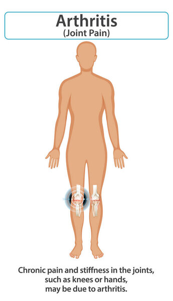 Illustration of arthritis affecting knee joints