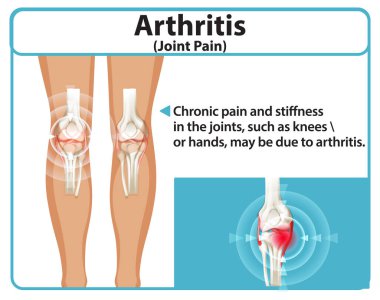 Kireçlenme, diz eklemlerini etkiliyor.