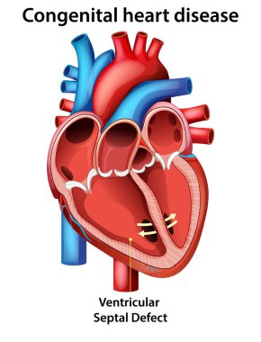 Ventriküler septal kusurlu, anatomik özellikleri ve kan akış yollarını vurgulayan bir insan kalbinin ayrıntılı çizimi