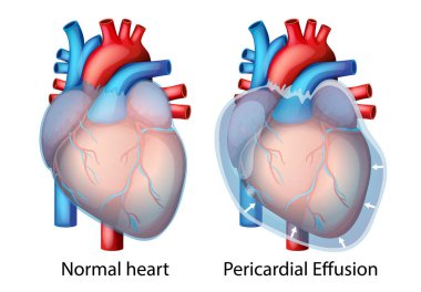 Sağlıklı bir kalple perikardiyal efüzyondan etkilenen, anatomik farklılıkları vurgulayan ve sıvı birikmesini sağlayan bir resim.