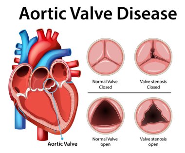 Aort kapakçığı hastalığının detaylı çizimi, etiketli kalp anatomisi ile normal ve stenoz koşullarını vurguluyor.