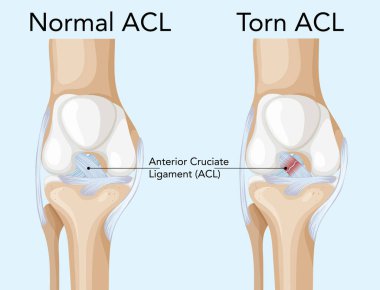 İnsan dizindeki normal ve yırtık ACL 'nin detaylı vektör çizimi, anatomik farklılıkları açık etiketleme ile vurguluyor