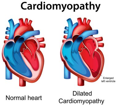 Normal bir kalp ve genişlemiş kardiyomiyopati gösteren vektör çizimi anatomik farklılıkları vurguluyor ve sol karıncığın genişlemesini gösteriyor.