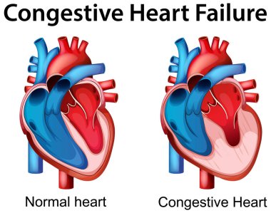 Normal ve konjestif kalpleri karşılaştıran detaylı vektör çizimi. Canlı renkler anatomik farklılıkları ve tıbbi koşulları vurguluyor