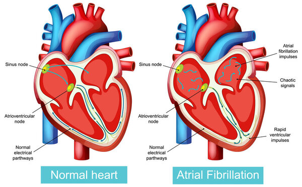 Detailed vector illustration contrasting normal heart function with atrial fibrillation, highlighting electrical pathways and nodes