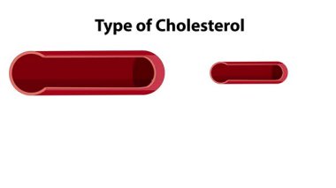 Animasyon sağlıklı ve aterosklerotik kan damarlarını gösteriyor.