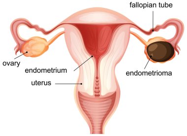 Rahim, yumurtalıklar ve endometriyomu vurgulayan dişi üreme sisteminin vektör çizimi. Etiketleri ve anatomik doğruluğu temizle