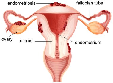 Kadın üreme sisteminde endometriyozisi vurgulayan vektör çizimi, etiketli anatomi ve canlı renkler