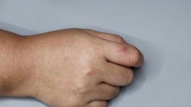 Parmak yaralanması kısa bir süre içinde iyileşir.