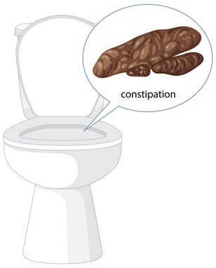 Tuvalet ve ayrıntılı tabure grafiğiyle kabızlığı vurgulayan vektör çizimi. Temiz çizgiler ve soluk renkler berraklığı artırır