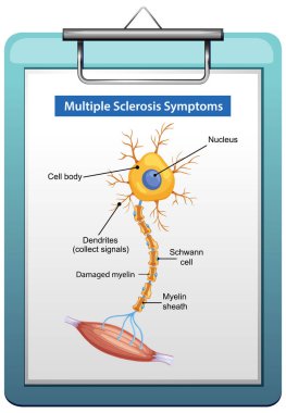 Zarar görmüş miyelin, etiketlenmiş parçalar ve temiz, düz renkli bir panoda çoklu skleroz belirtilerini gösteren bir nöronun vektör çizimi