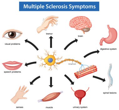 Renkli vektör illüstrasyonu beyin, kaslar, duyular, konuşma, görme, sindirim, idrar sistemi ve omuriliği etkileyen çoklu skleroz belirtileri gösteriyor.