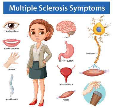 Vektör illüstrasyonu etiketli organlar, sinir sistemi unsurları ile çoklu skleroz belirtilerini vurgular ve klinik, eğitici tarzda ilgili bir kadın