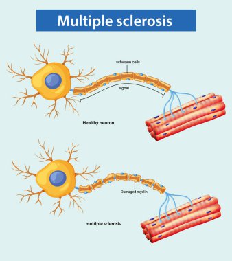 Sağlıklı ve çoklu skleroz etkilenmiş nöronları karşılaştıran vektör çizimi miyelin kılıfında hasar ve sinyal bozulması gösteriyor..