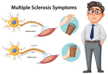 Semptom örnekleriyle çoklu sklerozdaki sağlıklı ve hasarlı nöronları karşılaştıran vektör diyagramı.