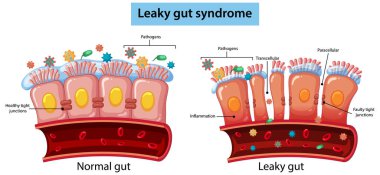 Düz vektör illüstrasyonu, sağlıklı ve sızdıran bağırsak dokusunu karşılaştırıyor. Düz bağlantı noktaları ve iltihap gösteriyor..