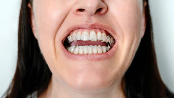Крупный План Неузнаваемой Женщины Использованием Ортодонтического Лечения Прозрачными Съемными Выравнивателями — стоковое фото