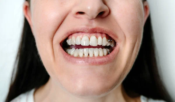 Κλείσιμο Αγνώριστη Γυναίκα Ανοιχτό Στόμα Δείχνει Συνημμένα Και Οδοντικά Κουμπιά — Φωτογραφία Αρχείου
