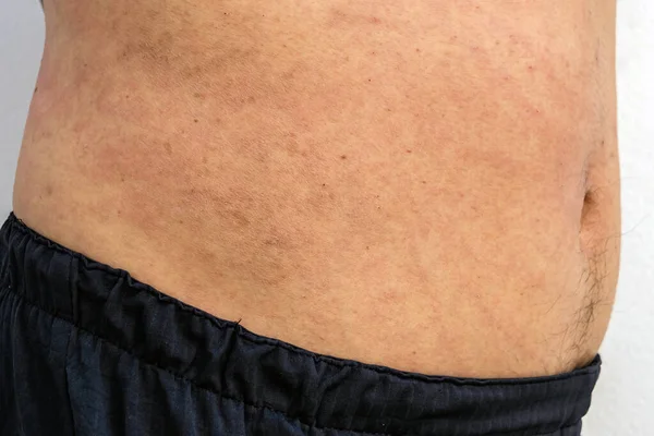 Itchy body rash caused by allergies on middle part of man body. Male torso with red allergic rash on stomach skin,atopic dermatitis,eczema,inflammation.Heat rush. Skin allergy. Scratch marks on skin.
