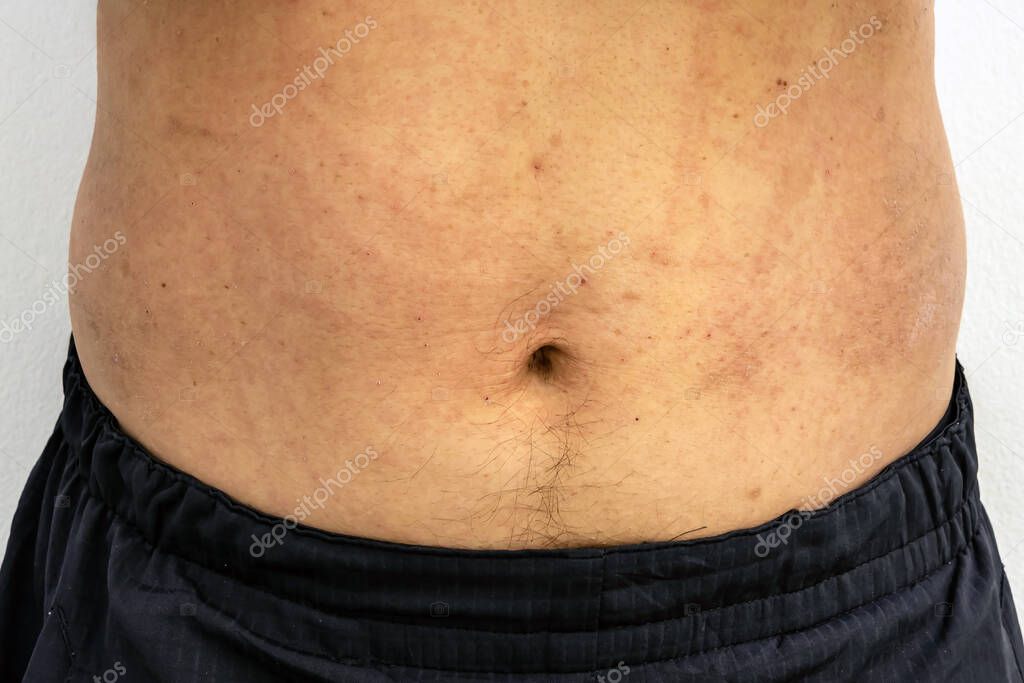 Sarpullido en el cuerpo causado por alergias en la parte media del