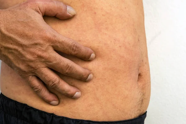 Man hand scratching an itch on red mark sensitive skin. Male torso with red allergic rash on stomach skin, atopic dermatitis, eczema, inflammation. Heat rush. Skin allergy. Scratch marks on the skin.