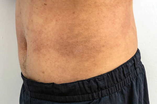 Itchy body rash caused by allergies on middle part of man body. Male torso with red allergic rash on stomach skin,atopic dermatitis,eczema,inflammation.Heat rush. Skin allergy. Scratch marks on skin.