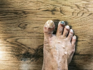 Dil altı hematom mavi siyah ayak tırnağı. Uzun ayak parmağının ya da işaret parmağının altında hematom var. Dil altı hematom, tırnak altında ya da ayak tırnağında kan oluşmasıdır. Siyah tırnaklı bir adamın ayakları. Çivi hastalığı.